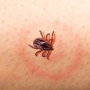Lyme Disease Bite Mobile