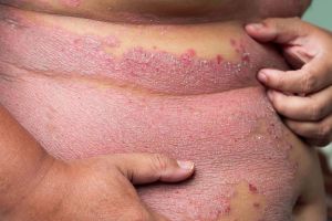 9, Psoriatic arthritis - Pure Medical Mobile