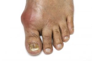 Gout Featured Image