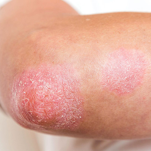 Psoriasis Causes Mobile - Pure Medical