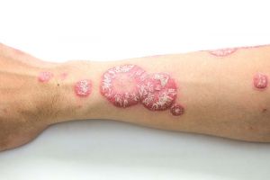 Psoriasis Feature Image
