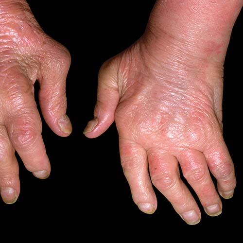Psoriatic Arthritis Diagnosis
