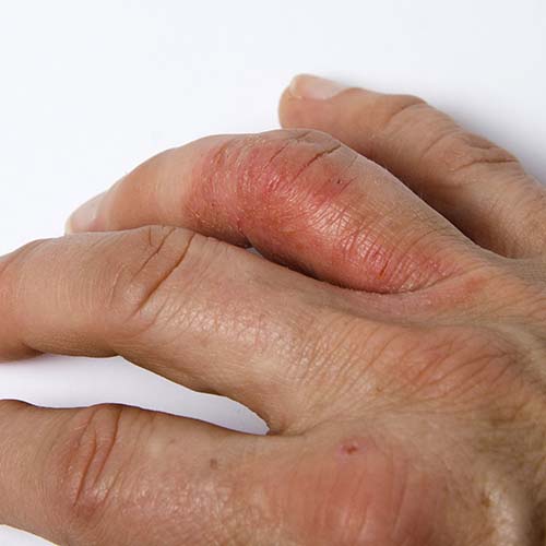 Psoriatic Arthritis Types