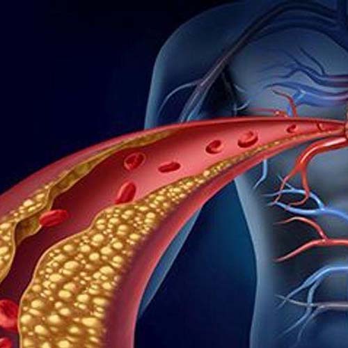 Pure Medical - Atherosclerosis - Complications