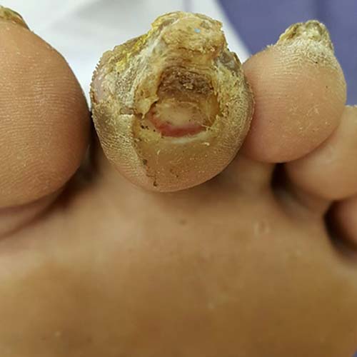 Pure Medical - Causes of Diabetic Foot Ulcer