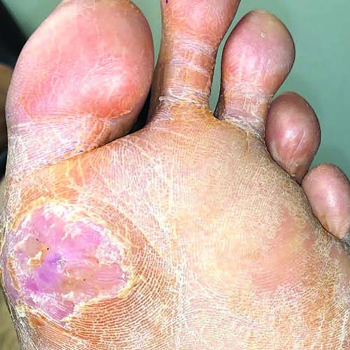 Pure Medical - Diabetic Foot Ulcer See GP
