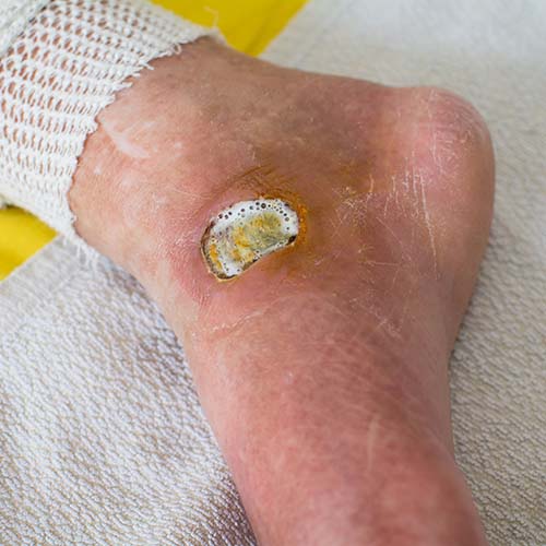 Pure Medical - Diabetic Foot Ulcer Statistics