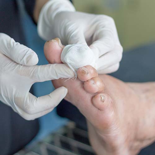 Pure Medical - Diabetic Foot Ulcer Summary