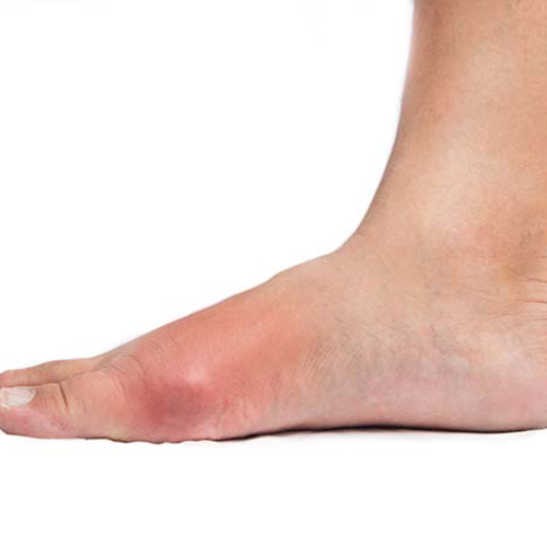 Pure Medical - Gout Summary