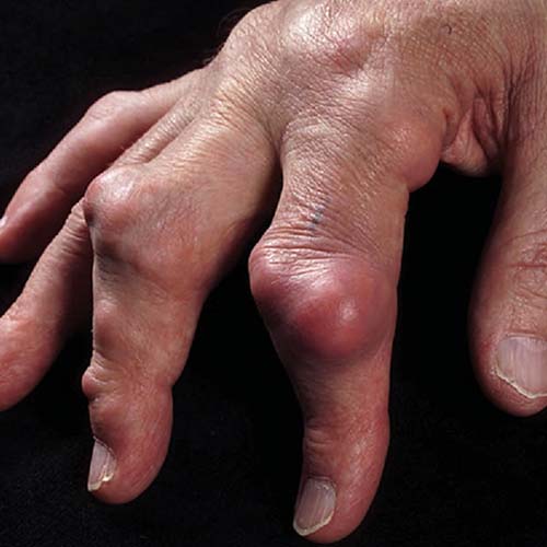 Pure Medical - Gout with tophus