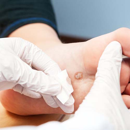 Pure Medical - Preventing a Diabetic Foot Ulcer