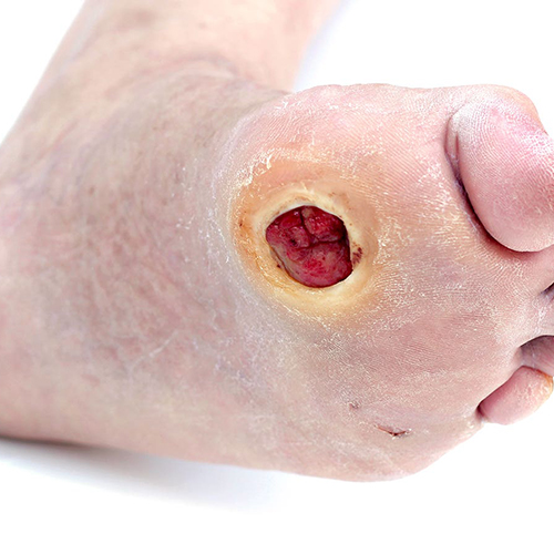 Pure Medical - Symptoms of Diabetic Foot Ulcers