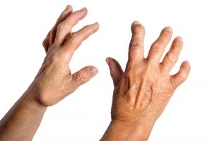 Pure Medical Hand Deformed From Rheumatoid Arthritis
