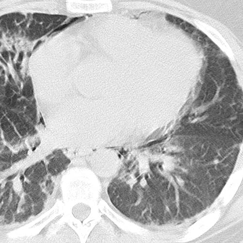 Pulmonary Fibrosis Summary