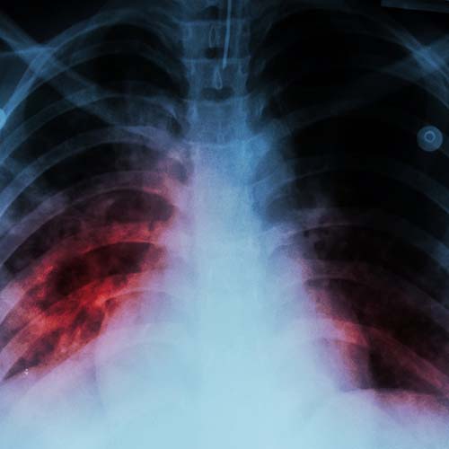 Pulmonary Fibrosis Symptoms