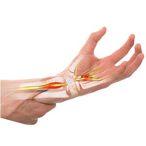 Pain Management - Carpal Tunnel Syndrome Pain