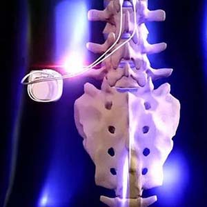 Pain Management - Spinal Cord Stimulation
