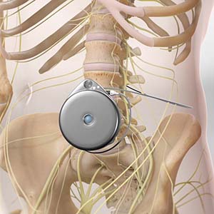 Pain Management - Spinal drug delivery systems