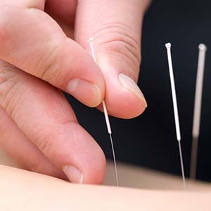 Pain Management - Acupuncture