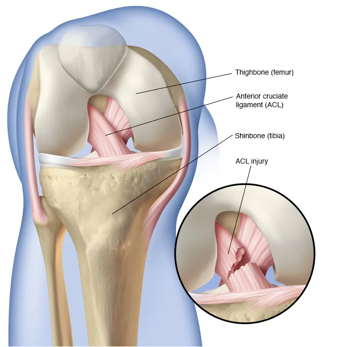 Knee Pain - ACL Injury