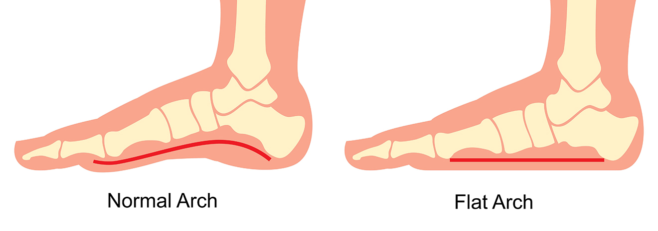 Flat Arch Foot Pain