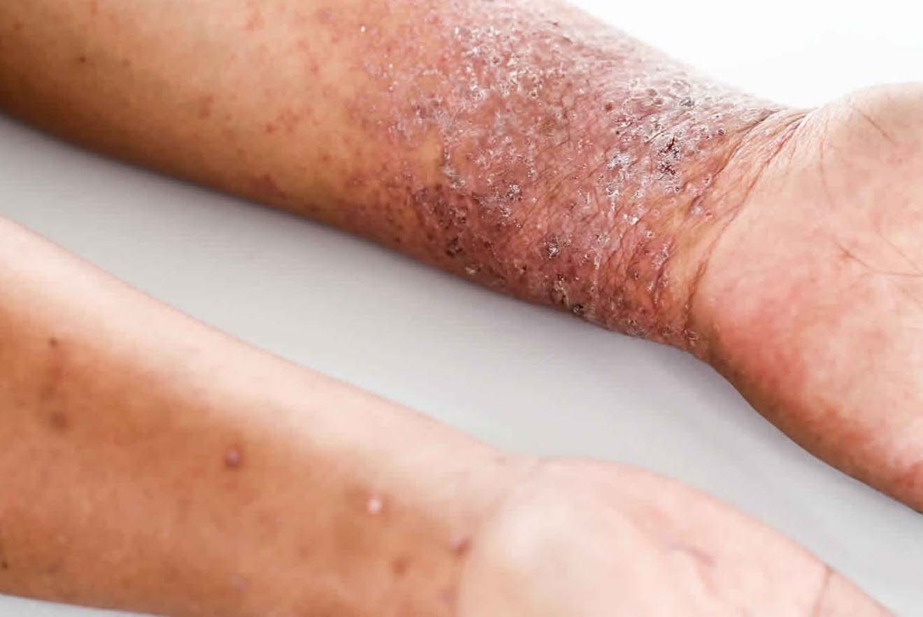 Atopic Dermatitis Symptoms Causes Triggers Pure Medical