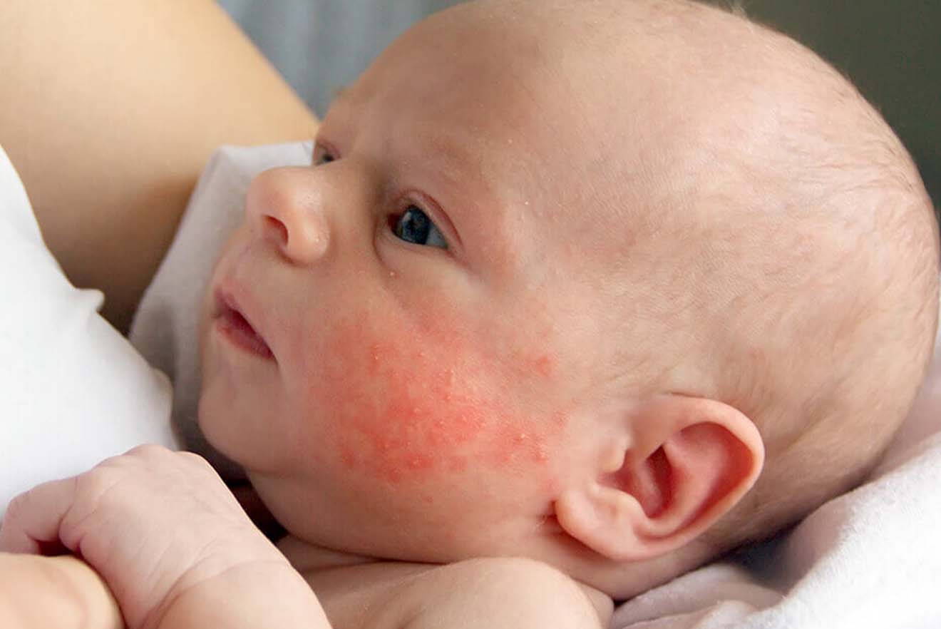 Baby Eczema Does My Baby Have Eczema? Pure Medical