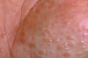 Dyshidrotic eczema