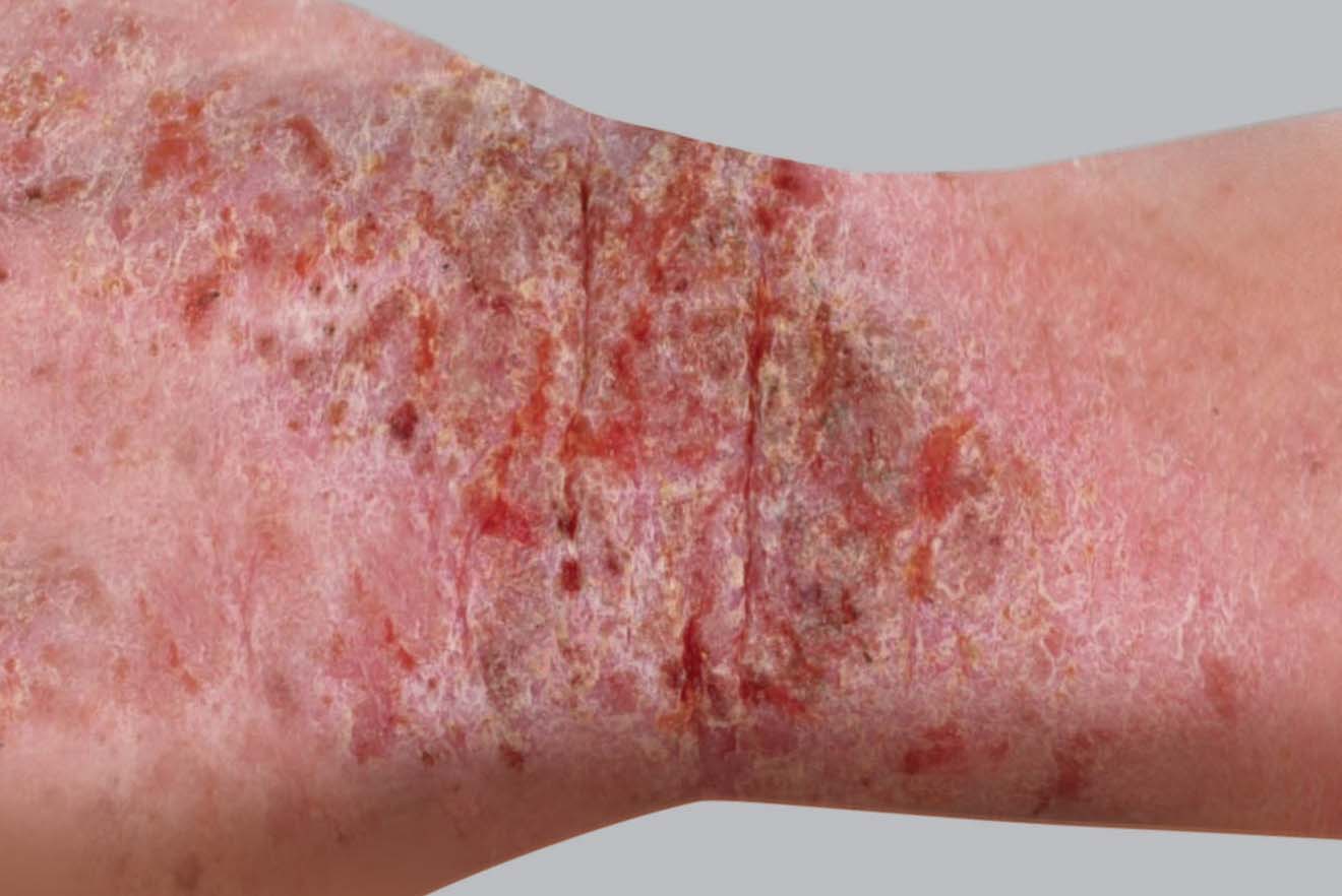 Atopic Dermatitis Risks and Eczema Causes Environment, and