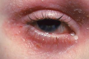 Eczema Diagnosis