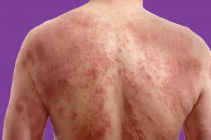 Eczema Prevention