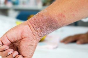 Eczema Symptoms