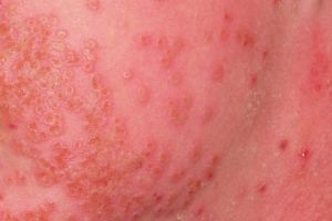 8 Different Types of Eczema