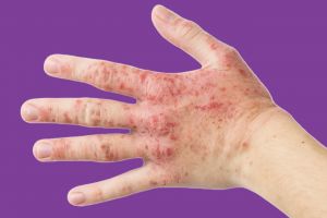 Hand eczema