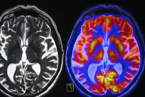 Hemiplegic Migraine