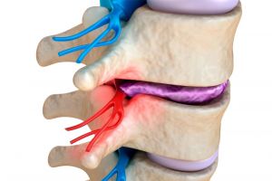Pinched nerve