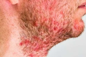 Seborrheic Dermatitis