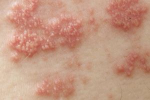 Shingles Pain