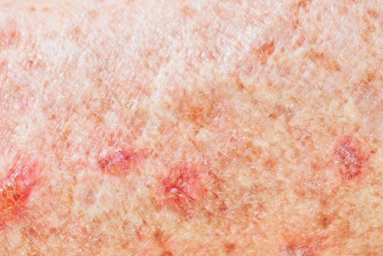 Skin Treatment Centre Skin Problems And Treatments Pure Medical