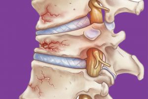 Spinal Compression Fractures