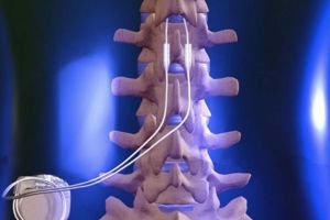 Spinal Cord Stimulation