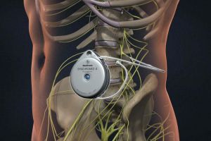 Spinal Drug Delivery Systems
