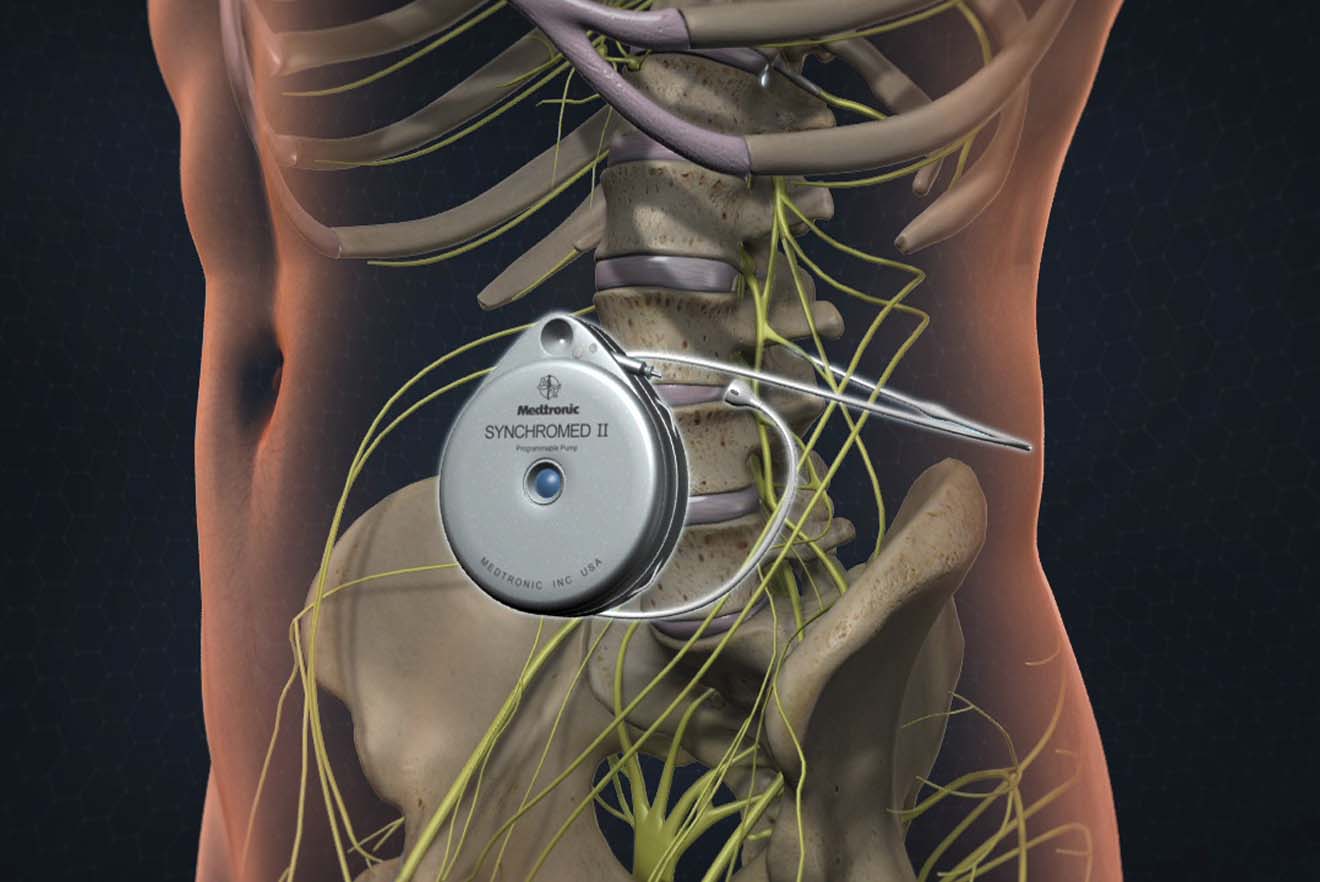 Spinal Drug Delivery Systems Providing Pain Relief - Pure Medical