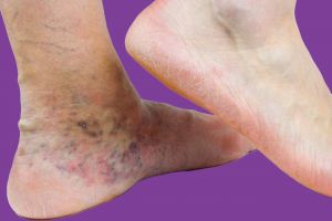 Venous Stasis Dermatitis