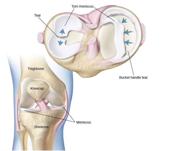 Knee Pain - Torn Meniscus