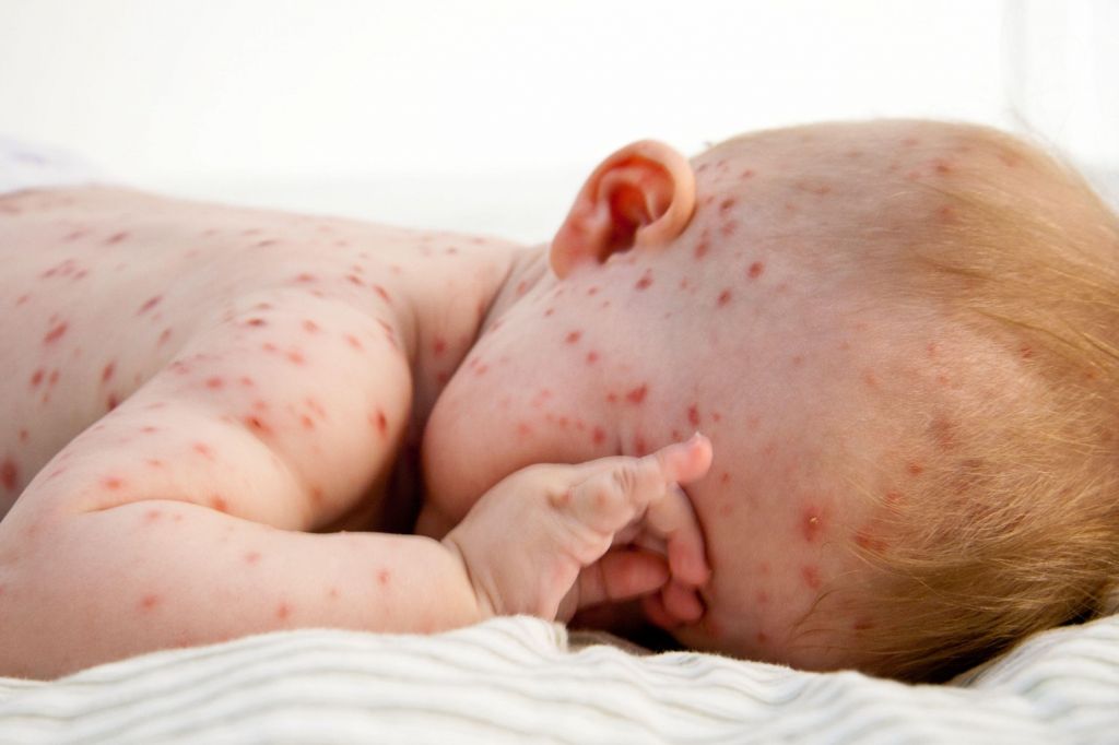 Childs Skin Rash - Chickenpox