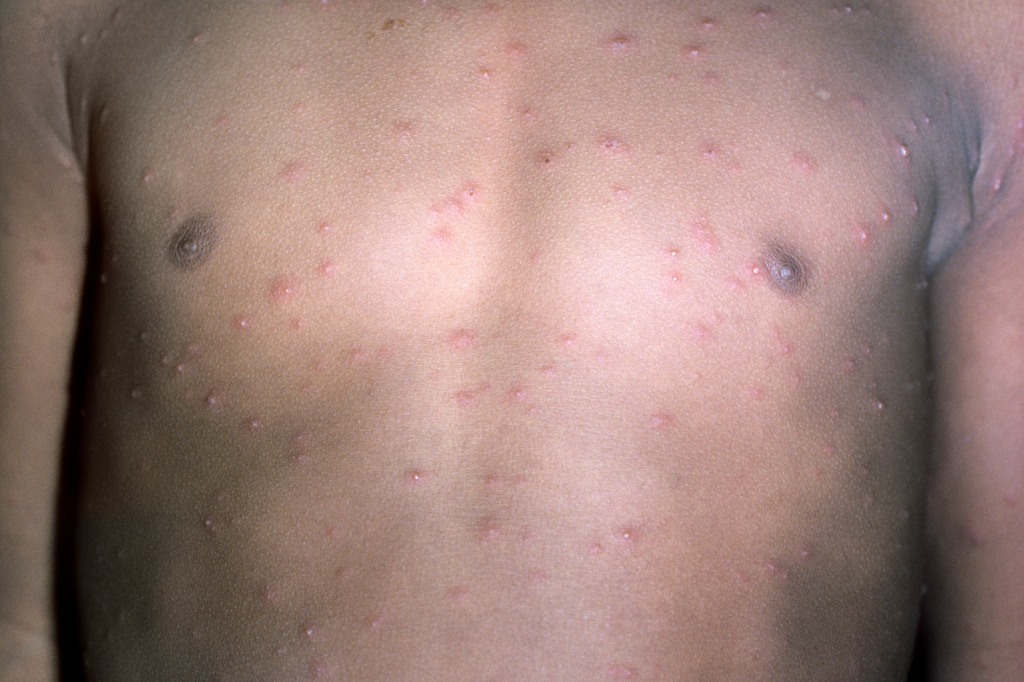 Childs Skin Rash - Chickenpox in child