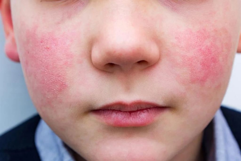 Common Child Skin Problems - Fifth Disease