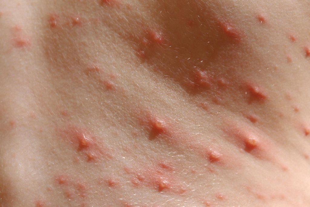 Common Child Skin Problems - Chicken Pox