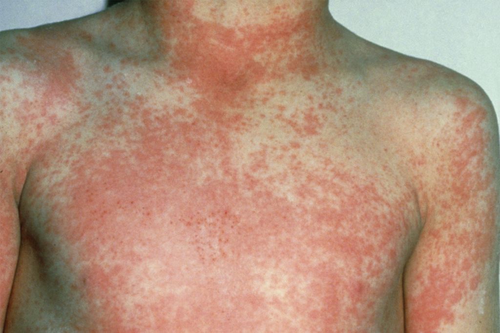 Childs Skin Rash - Scarlet Fever